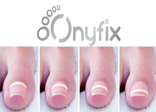 Sistema Onyfix para corrección de uñas encarnadas